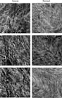 These second-harmonic-generation (SHG) images depict single optical sections of ex vivo human ovarian tissue. The malignant tumors are high-grade serous tumors as classified as pathology (left column). The field size in each case is 170 × 170 μm. The images were acquired at 40X 0.8 NA at zoom 2 using 890 nm excitation in the forward detection, isolated with a bandpass filter, and detected by a single-photon-counting photomultiplier.